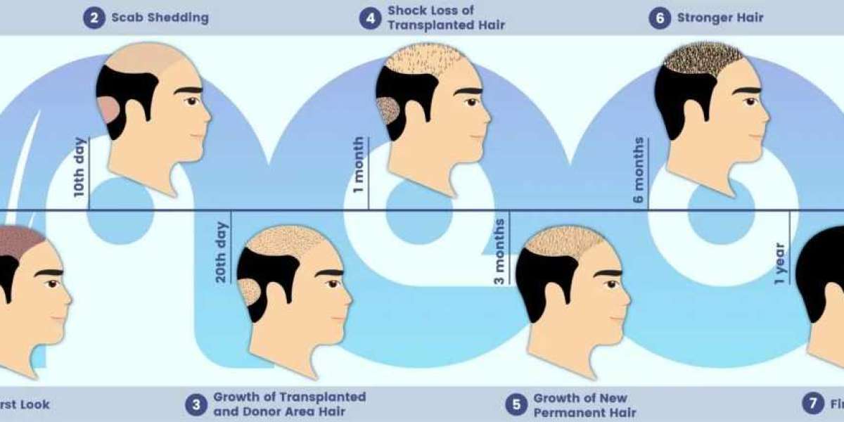 Hair Replacement in Turkey: A Leading Solution for Hair Loss